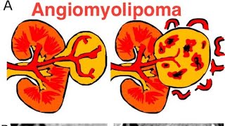 Angiomyolipoma [upl. by Gianina]