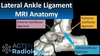 MRI Anatomy of lateral ankle ligaments [upl. by Donaldson252]