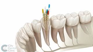 Endodontie  Wurzelbehandlung  City Dental Clinic Bratislava [upl. by Aohsoj784]