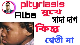 pityriasis Alba  মুখে সাদা দাগ। কিন্তু শ্বেতী না। জেনে নিন কি। কারণ ও চিকিৎসা। [upl. by Lewej]