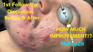 Severe Acne Follow up How did he do One round of extractions done [upl. by Yenobe]