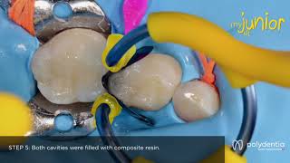 Restoration of a primary molar with myClip Junior Clinical Case by Dr Marina Papachroni [upl. by Argella]