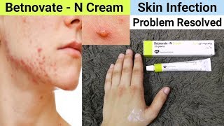 Betnovate N Cream Review  Benefits amp Uses  Betnovate N Cream for Face Acne Pimples [upl. by Hiett]