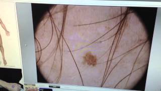 microfinder  microderm dermoscopy  diagnosis [upl. by Gilleod]