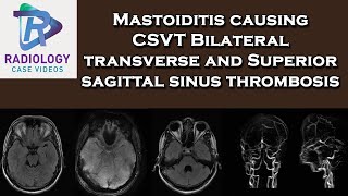 Mastoiditis causing CSVT Bilateral transverse and Superior sagittal sinus thrombosis [upl. by Vange]