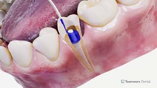 Root Canal with Post and Crown [upl. by Neidhardt858]