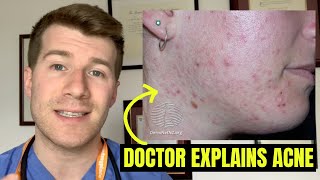 Doctor explains ACNE symptoms selfcare treatment options and complications [upl. by Sinclair829]