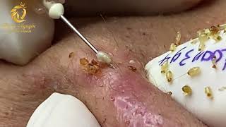 Treatment of blackheads and whiteheads 394  Loan Nguyen [upl. by Irtemed]