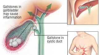 Cholecystitis [upl. by Feledy800]