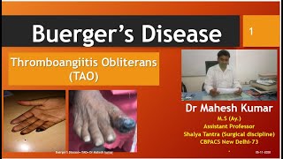 Buergers DiseaseTAOThromboangitis obliteransarterial diseasesPeripheral vascular diseaseMahesh [upl. by Dietsche]