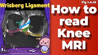 Fig 1A10 Meniscofemoral ligament Wrisberg ligament [upl. by Hareema543]