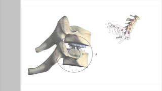 ROTAIO Zervikale Bandscheibenprothese [upl. by Piers]