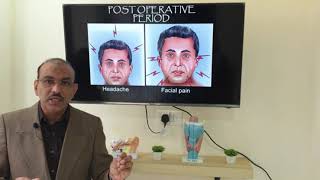 Deviated nasal septum Tamil Patient teaching programme [upl. by Iarised543]