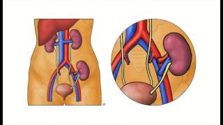 Kidney Transplantation  The Operation [upl. by Sephira]