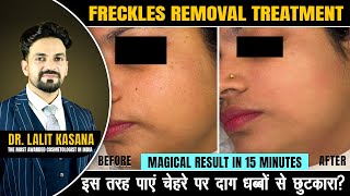 Freckles Removal Treatment  Magical Result in Minutes  DrLalit Kasana [upl. by Akerboom354]