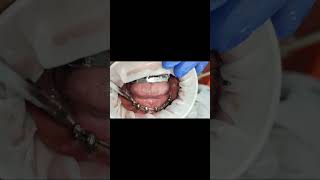 Regular single piece implants Vs multiunit single piece implantshealingamptapping test post 6 months [upl. by Schroth664]