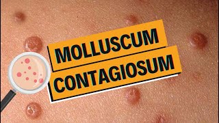 Molluscum contagiosum  comment les soigner [upl. by Ardnasirhc]