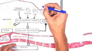 Burns DETAILED Overview  Types Pathophysiology TBSA [upl. by Chun897]