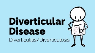 Diverticular Disease  Diverticulitis  Gastrointestinal Society [upl. by Intruok]