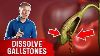 Do This to Help Dissolve Gallstones [upl. by Amye693]