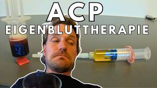 ACP Eigenbluttherapie für die Patellasehne  die erste Sitzung [upl. by Uahc916]