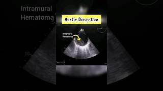 Aortic Dissection and Intramural Hematoma  Echocardiography for Beginners Echo [upl. by Judon720]