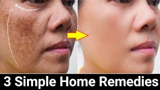 Remove Face Pigmentation Naturally [upl. by Alexei]