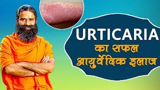 Ayurvedic Treatment Of Urticaria शीतपित्त  Swami Ramdev [upl. by Kai]