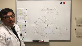 Junctional Scotoma [upl. by Kristen]