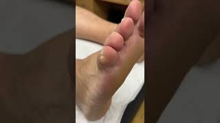 Step into relief with our Aussie podiatrist’s 5th toe corn amp callus removal [upl. by Adriano22]