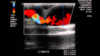 Dialysis Access Evaluation  Case Study [upl. by Nael]