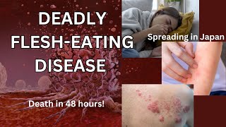 Deadly FleshEating Disease  STSS  News  What you need to know [upl. by Hepzi]