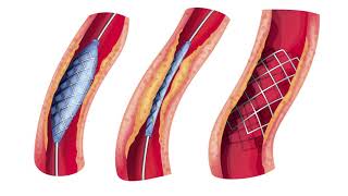 Enfermedad arterial periférica síntomas y tratamiento │Unique Interventional Radiology [upl. by Lyda]