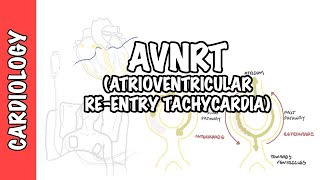 AVRNT atrioventricular reentry tachycardia  causes pathophysiology treatment [upl. by Ramsay]