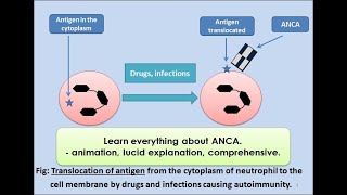 ANCA Anti Neutrophilic Cytoplasmic Antibody pathology vasculitis [upl. by Inan]