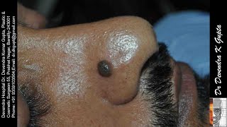 14 Congenital pigmented or melanocytic nevus Mole Ala of the Nose [upl. by Ellainad150]