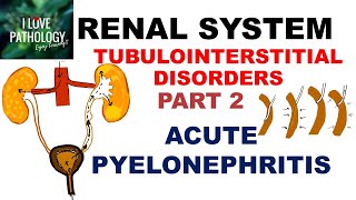 ACUTE PYELONEPHRITIS Pathology [upl. by Higinbotham]