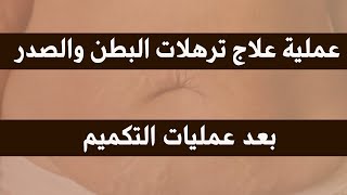 عملية شد ترهلات البطن والصدر بعد عملية التكميم  ريجينورا كلينك  محمد أمين جراح التجميل [upl. by Nylekcaj]