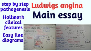 Ludwigs angina [upl. by Rea395]