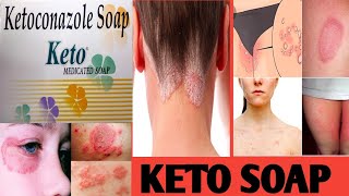 Keto soap review in hindi  ketoconazole soap use in hindi [upl. by Ahsaeyt]