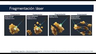 Ureterorrenoscopía flexible litotricia láser fragmentación y pulverización [upl. by Isle641]