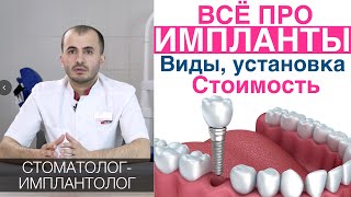 Зубные импланты  как выбирать цена установка имплантов зубов гарантия Имплантация зубов [upl. by Dombrowski]