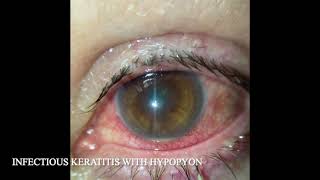 INFECTIOUS KERATITIS WITH HYPOPYON [upl. by Zebadiah]