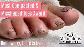 How to Pedicure Transformation the Most Compacted amp Misshapen Toenails [upl. by Ayetal349]