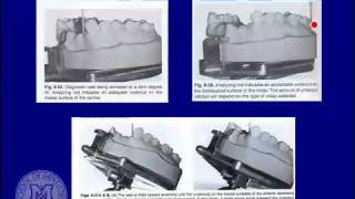 DENT 718 Rotational path partial dentures [upl. by Gib]