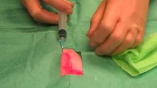 Suturing 1 Infiltrating local anaesthetic [upl. by Mychal574]