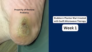 Plantar Wart treatment Before And After Images [upl. by Attennaej391]