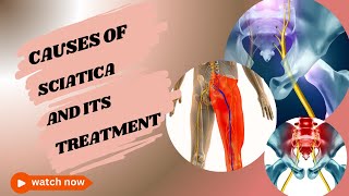 Different Causes of Sciatica and its Treatment [upl. by Janeczka360]