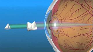 Multifocal Lens IOL [upl. by Satsoc]