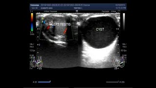 Ultrasound Video showing Epididymal cysts in both testes in a child of about 18 moths [upl. by Zoellick738]